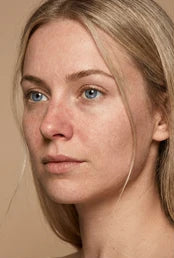 Customer dry skin appearance before using the overnight mask